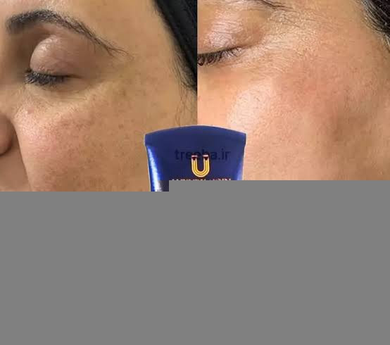 کرم لاکچری کوین برطرف کننده لک های ملاسما