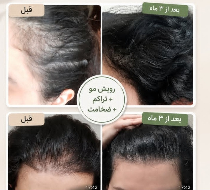 پک اکونومی رویش مجدد مو/تونیک هیرفرند+تونیک رویش مجدد مو بیز+شامپو مورینگا اکسونیک
