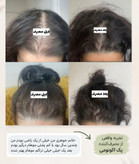 پک اکونومی رویش مجدد مو/تونیک هیرفرند+تونیک رویش مجدد مو بیز+شامپو مورینگا اکسونیک