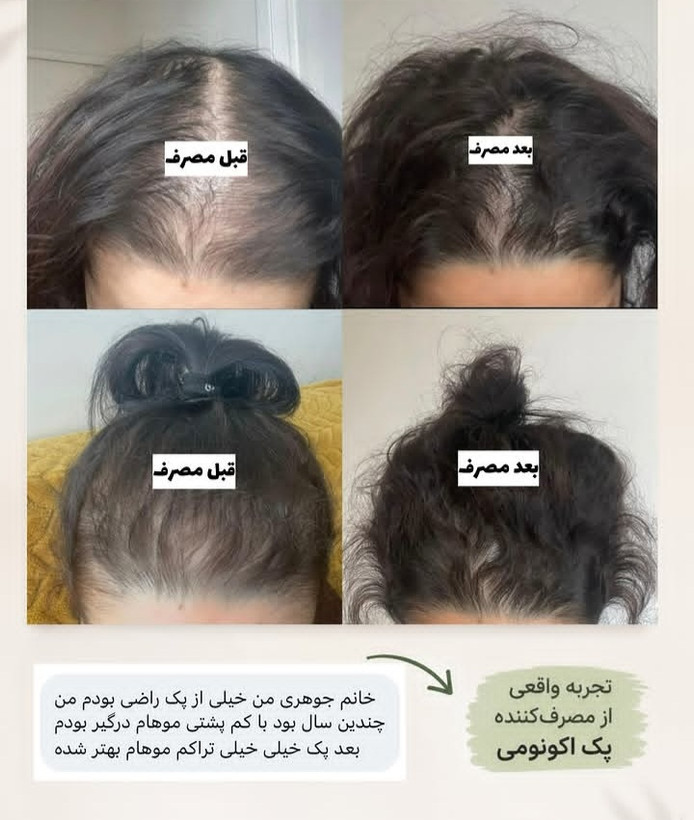 پک اکونومی رویش مجدد مو/تونیک هیرفرند+تونیک رویش مجدد مو بیز+شامپو مورینگا اکسونیک